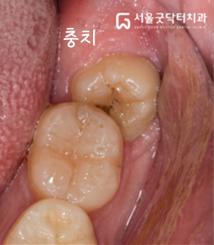 암사역치과 인접 치아 영향 설명 이미지
