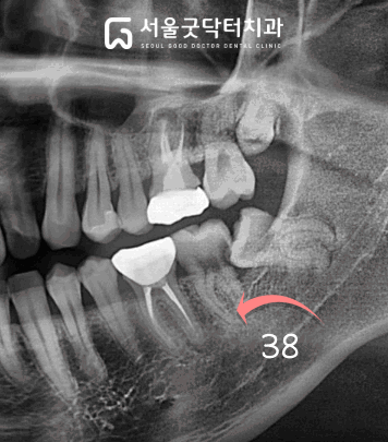 매복 방향 및 각도 설명