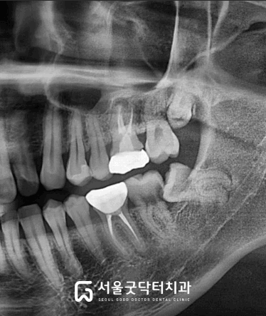 뿌리 형태 만곡 융합 분지 설명 이미지