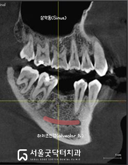파노라마 CT 촬영