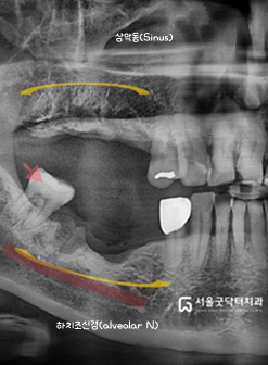 하악 하치조신경