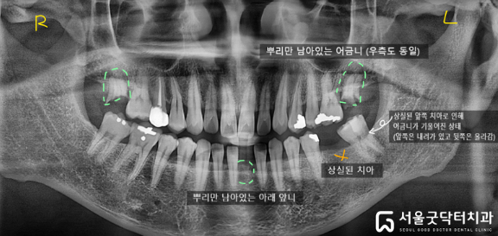 초진 파노라마 방사선 사진