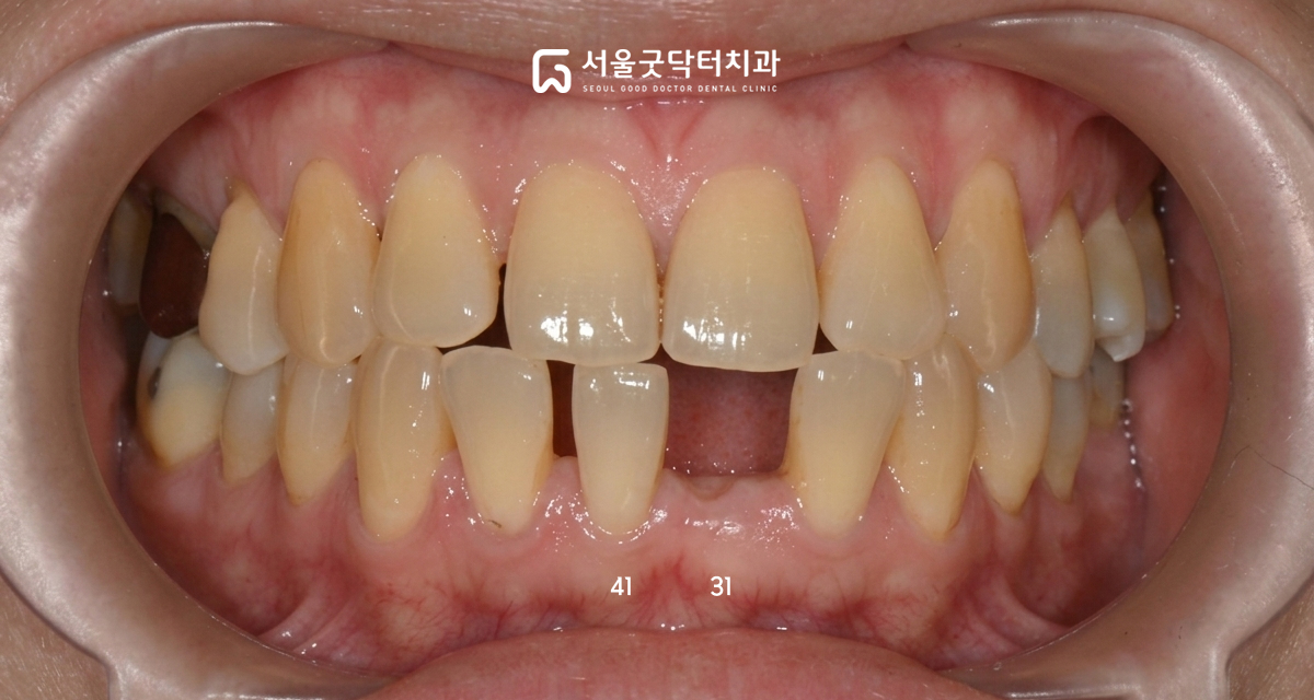 초진 구강 내 사진