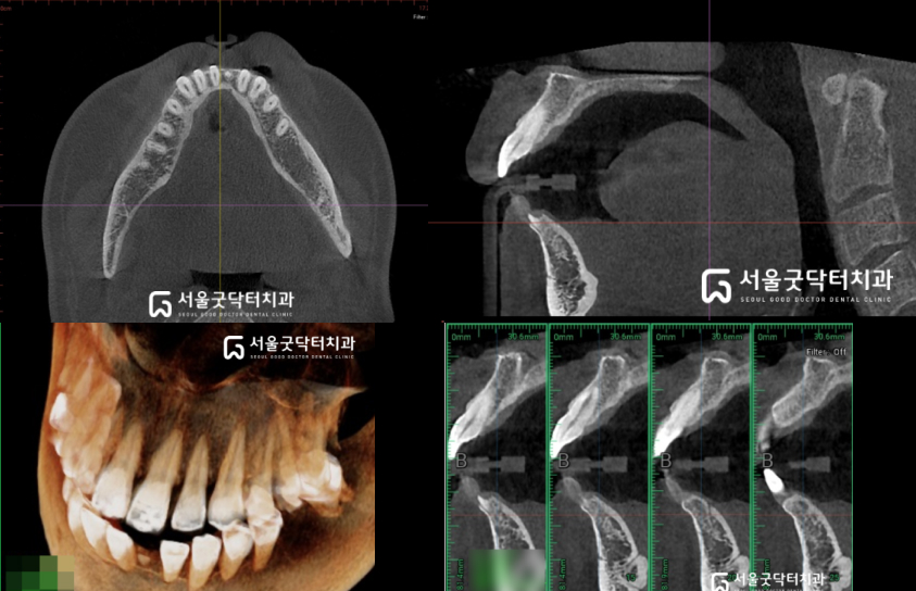 수술 전 CT 단층 영상