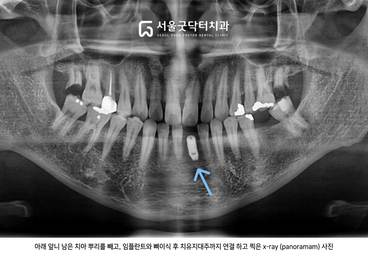 식립 후 파노라마 방사선 사진