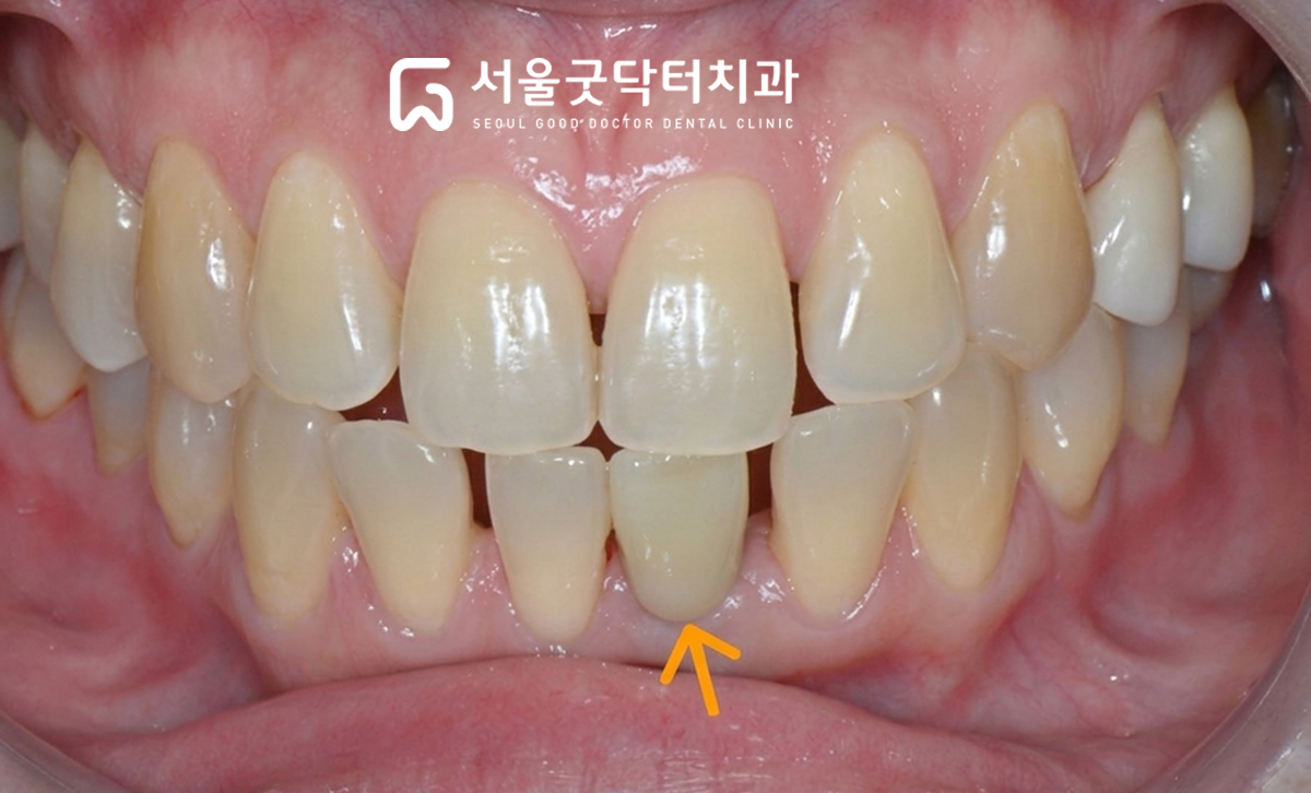 보철 수복 후 구강 내 사진