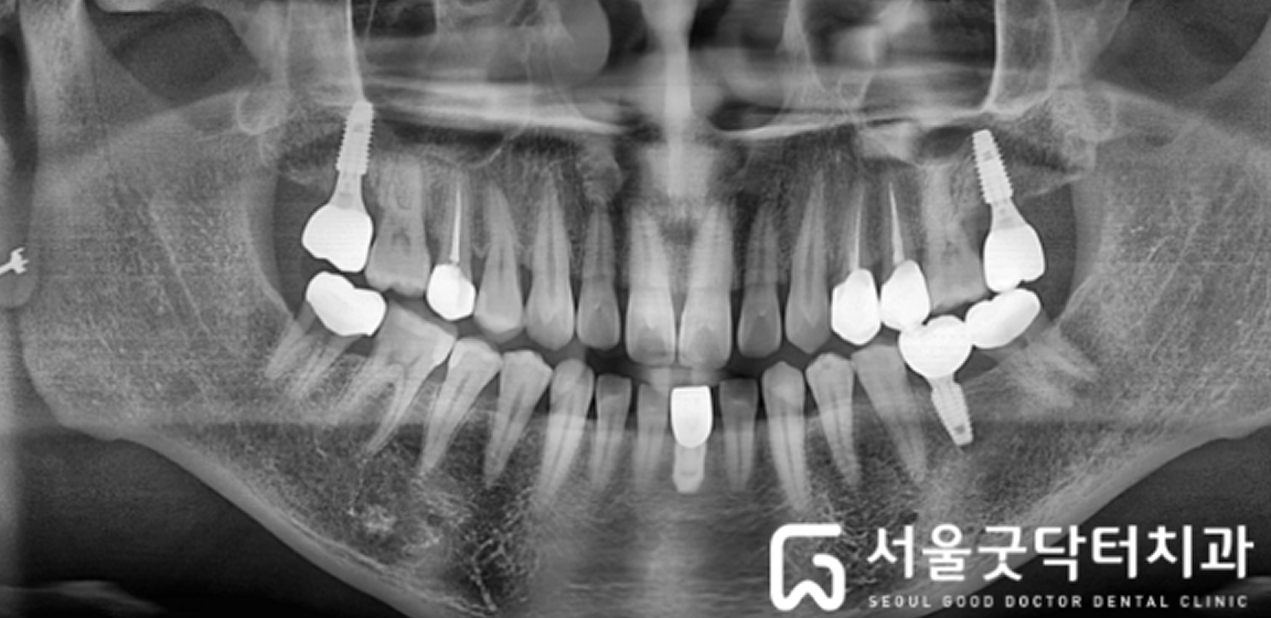 보철 수복 후 파노라마 방사선 사진