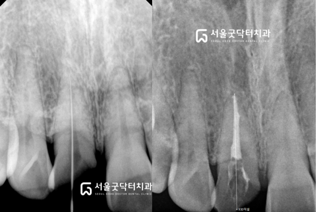 신경치료 진행 — 왼쪽 충전 전, 오른쪽 충전 후
