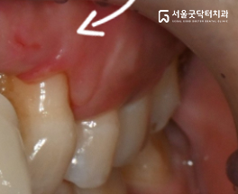 조직유도재생술 회복 후 경과 사진 2
