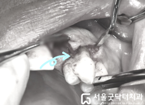 치근면 처치 후 깨끗해진 치근 상태 사진 1