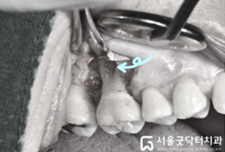 치근면 처치 후 깨끗해진 치근 상태 사진 2