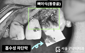 조직유도재생술에 사용된 뼈이식재 사진