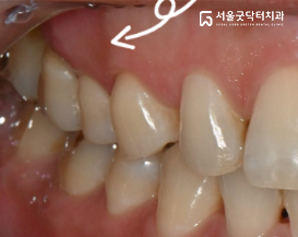 조직유도재생술 회복 후 경과 사진 1