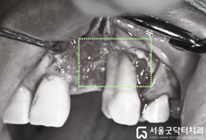치근면 처치 후 깨끗해진 치근 상태 사진 3