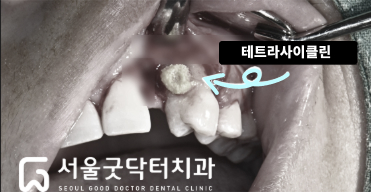테트라사이클린으로 치근면을 처치하는 예시 사진
