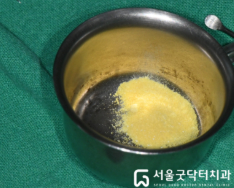 치근면 처치에 사용한 테트라사이클린 분말 사진