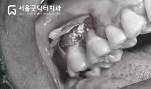 조직유도재생술에 사용된 차단막 사진