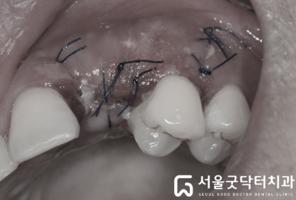 조직유도재생술 봉합(suture) 사진