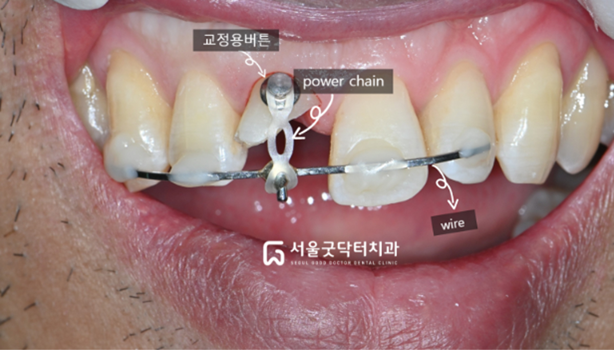 의도적 정출을 위한 와이어, 버튼, 파워체인 사용