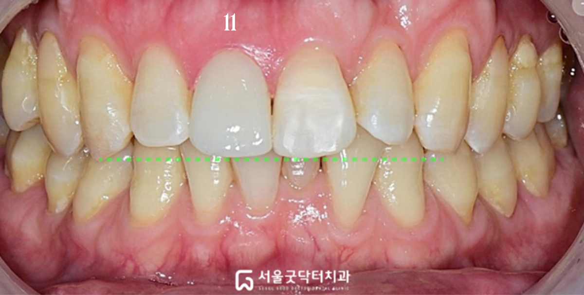 지르코니아 크라운 수복 완료