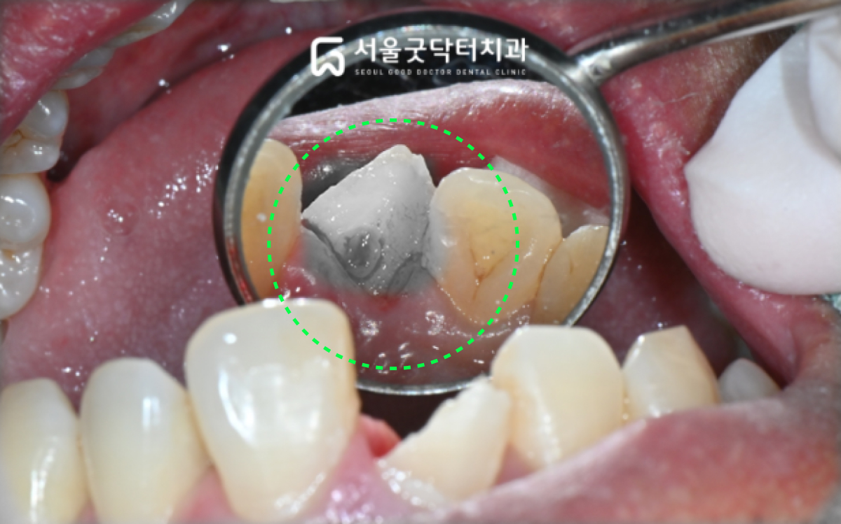 초진 구강내 사진 — 절단연 치수노출