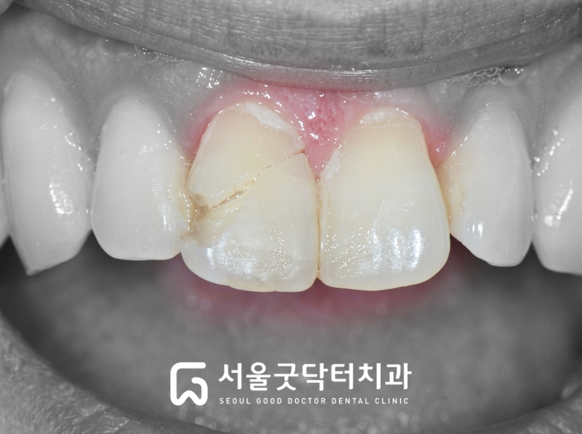 초진 구강 내 사진 — 앞니 파절 상태