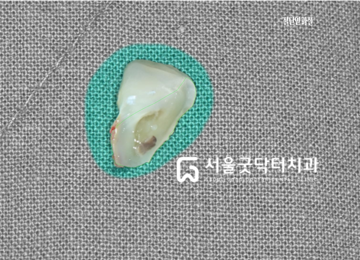 치아 파절편 — 절단연 부위